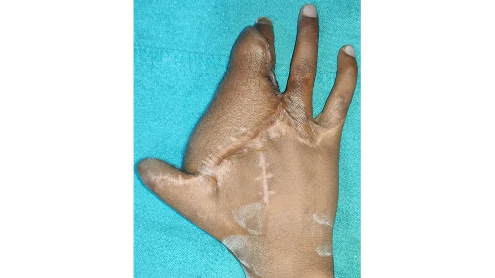 Electric Burn — after