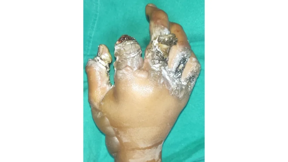 Electric Burn — before