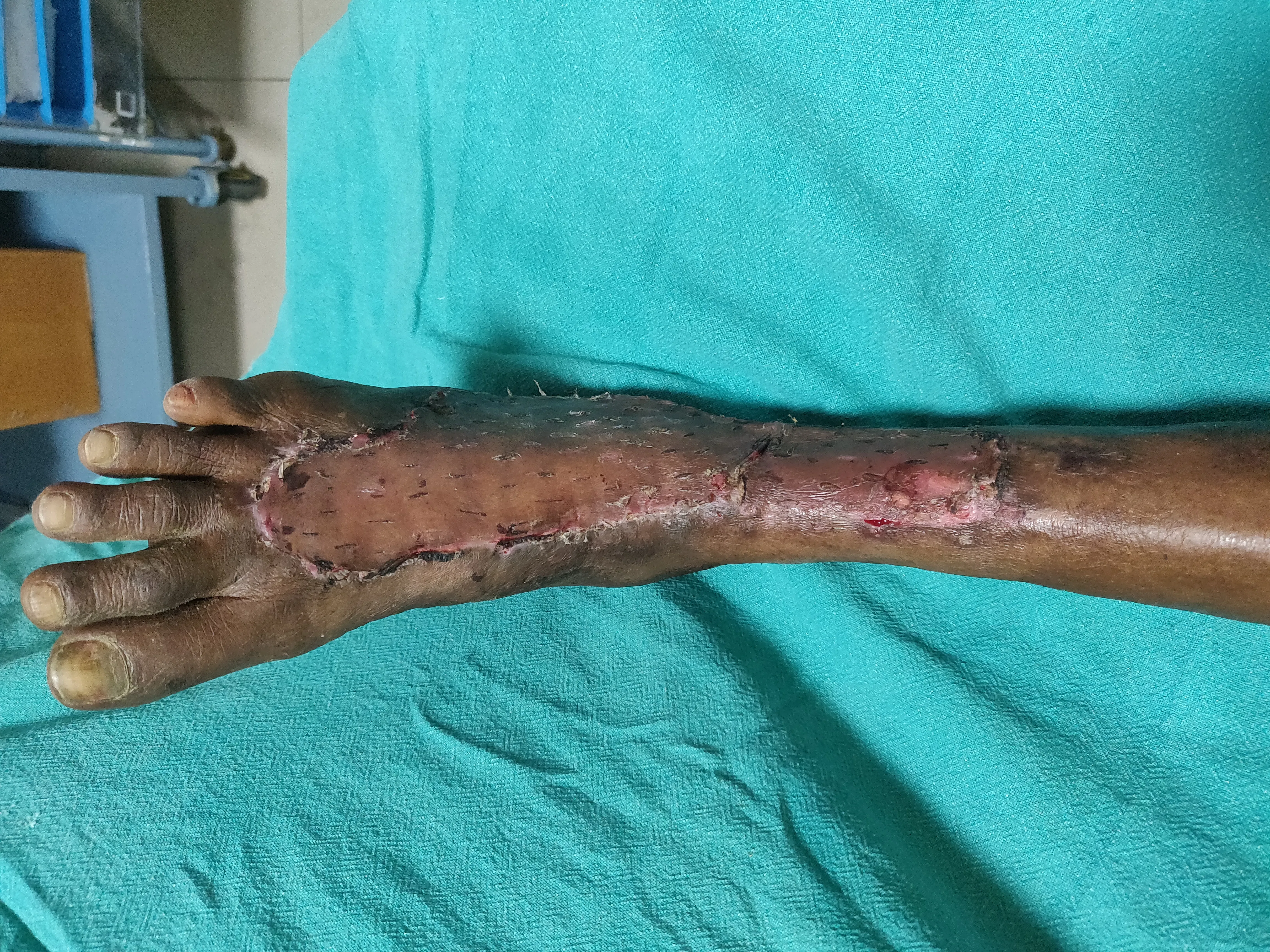 Diabetic Foot Infections — after