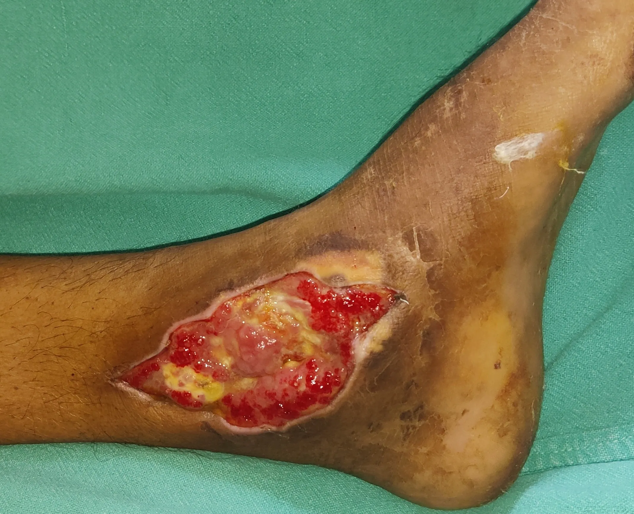 Diabetic Foot Surgery — before