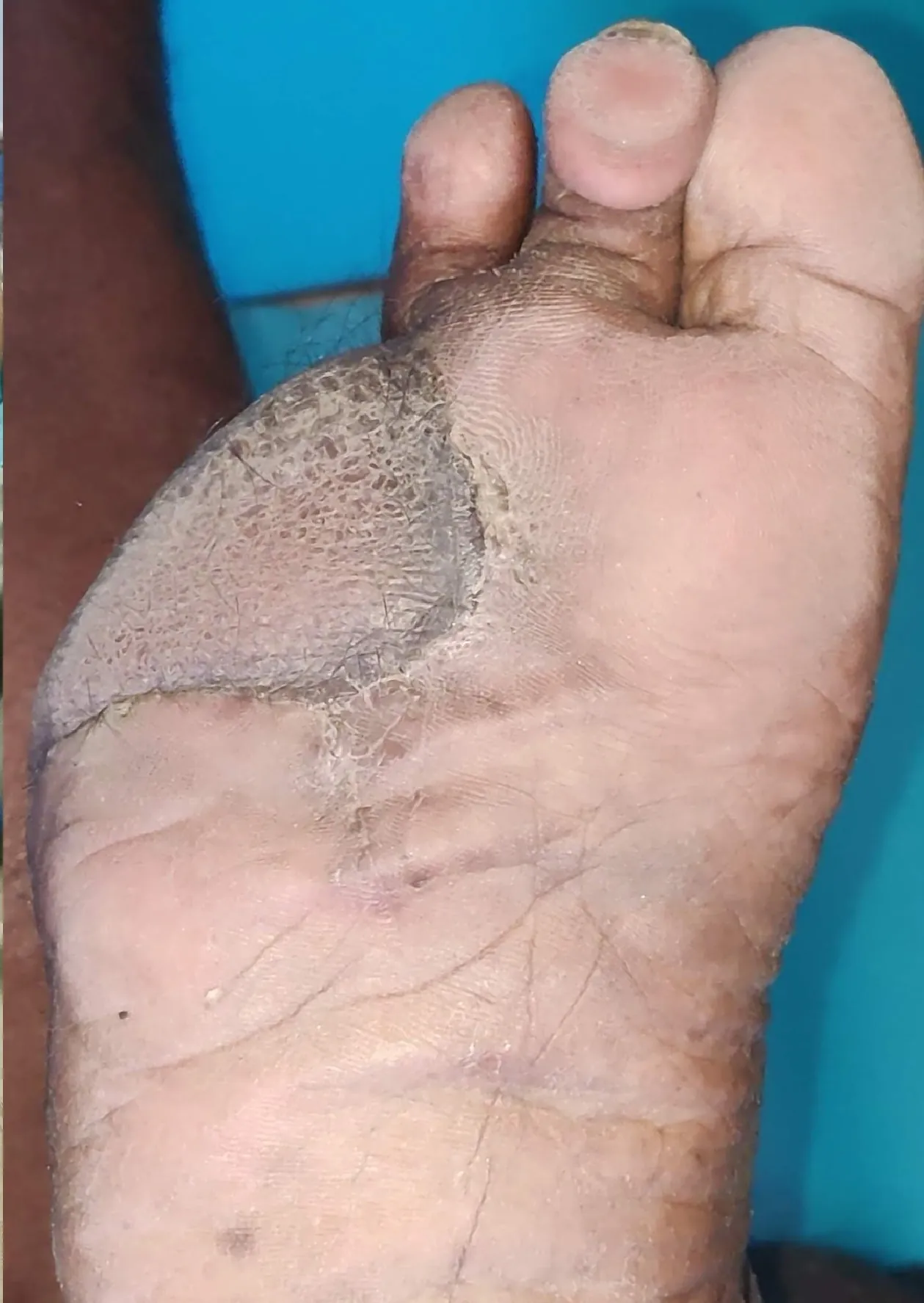 Diabetic Foot Surgery — after