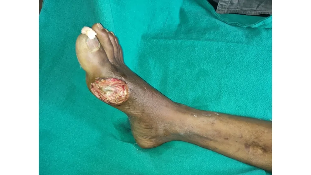 Diabetic Foot Surgery — before