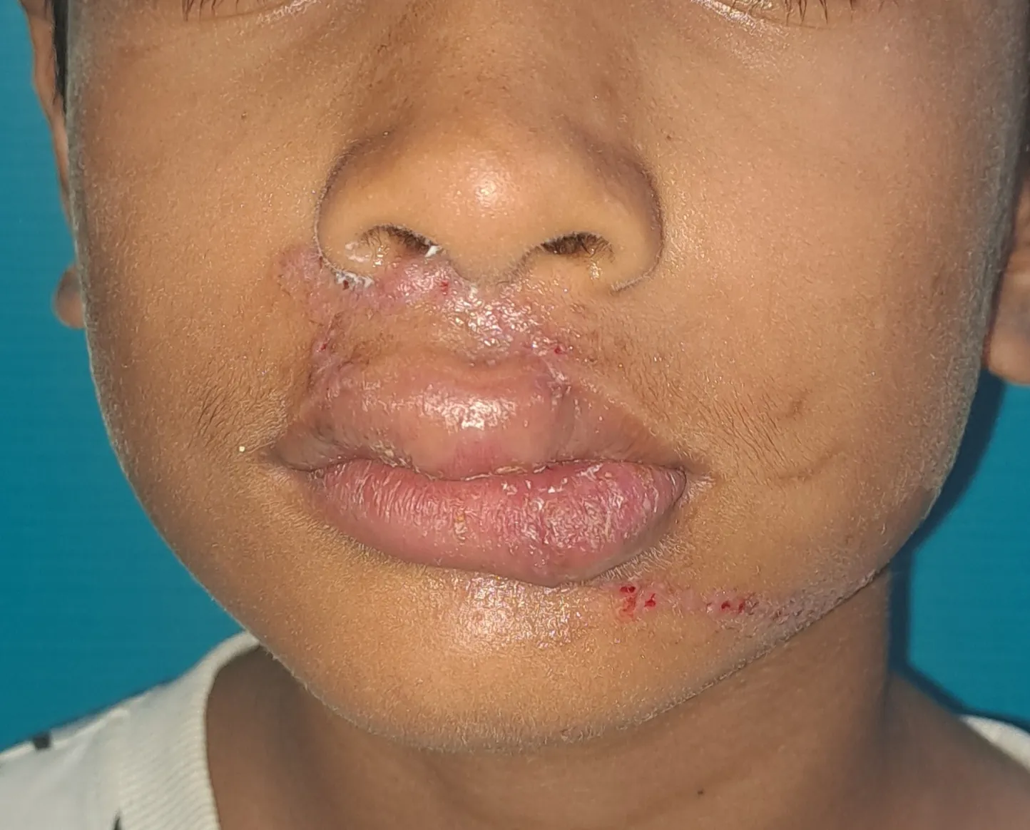 Face Injuries — after