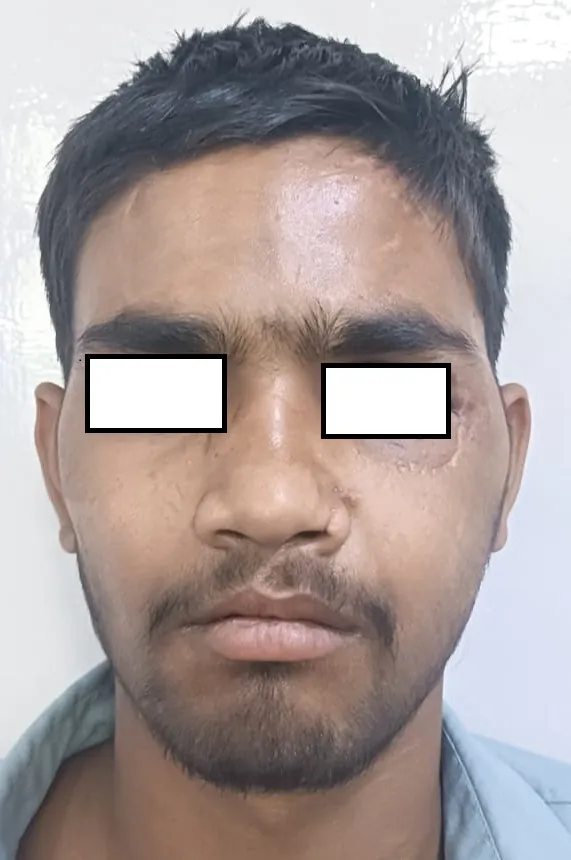 Facial Fractures — after
