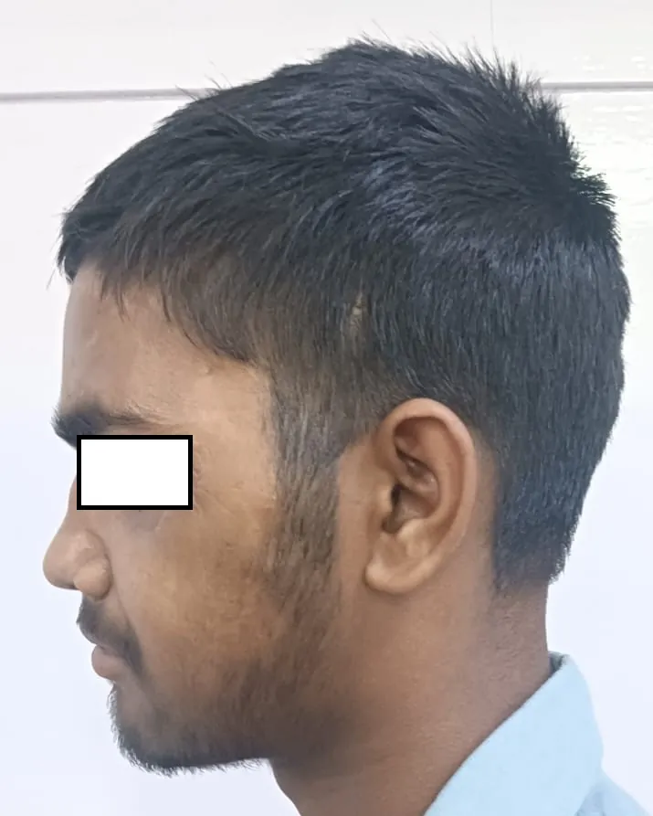 Facial Fractures — after