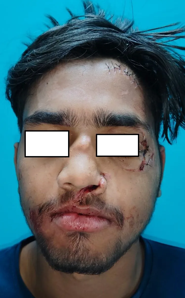 Facial Fractures — before