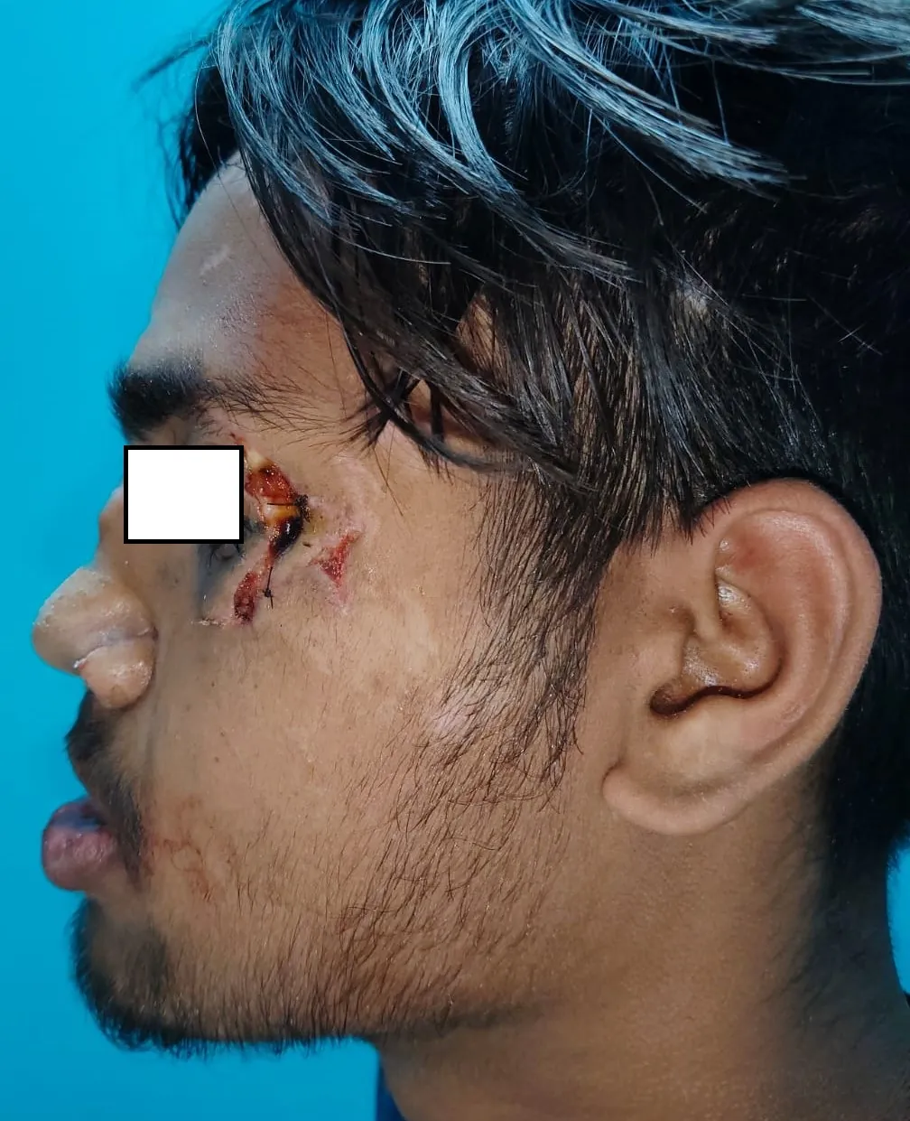 Facial Fractures — before