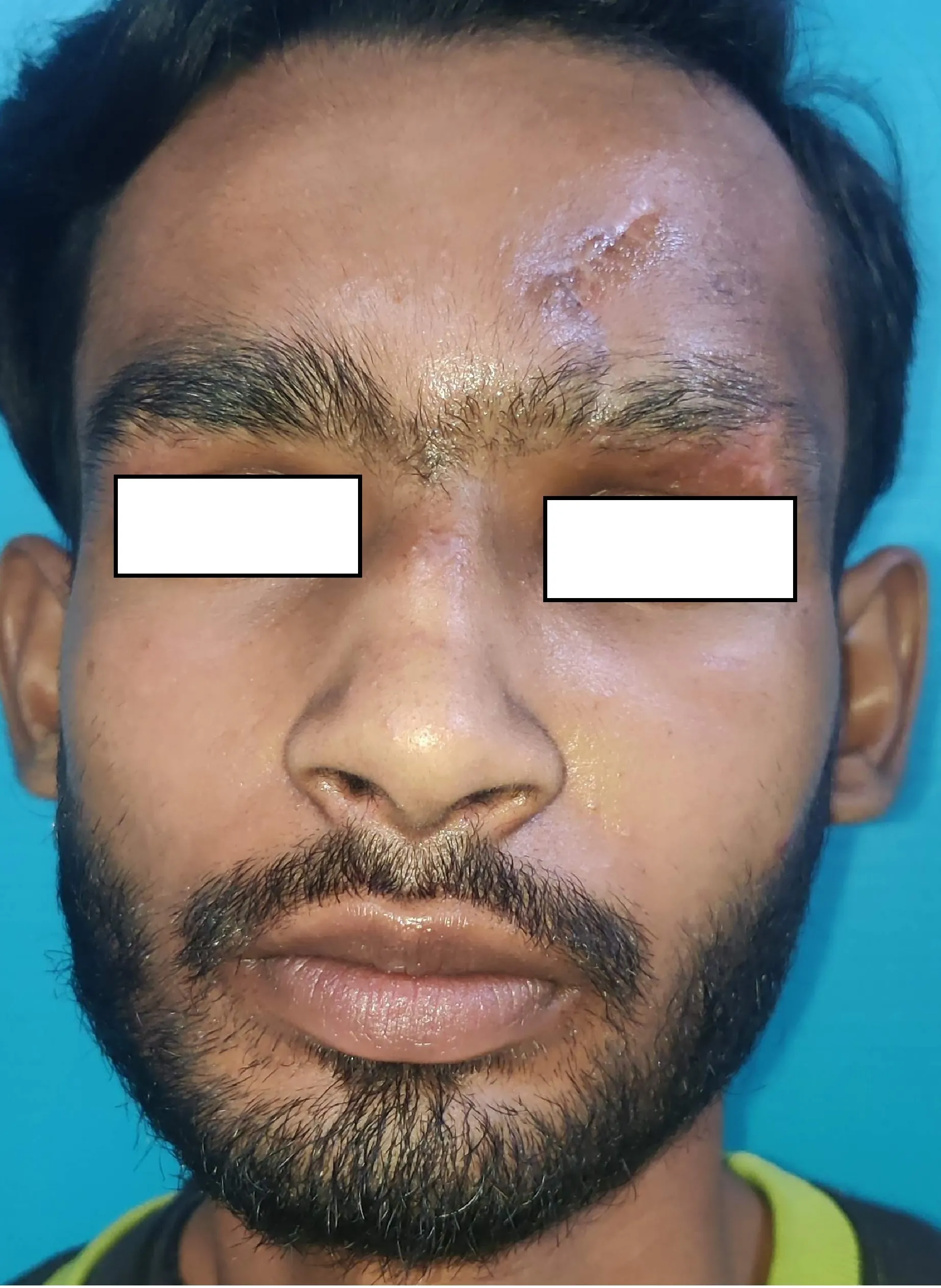 Facial Fractures — after