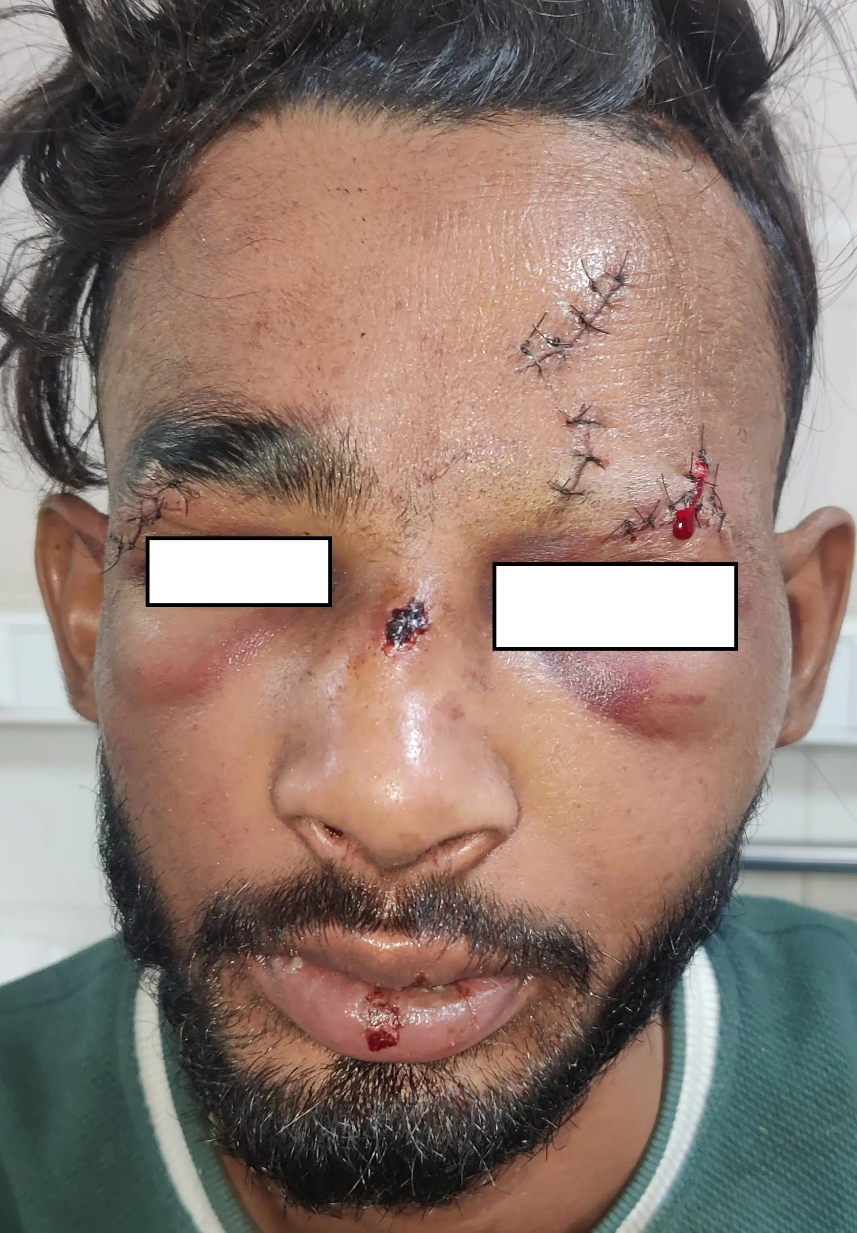 Facial Fractures — before