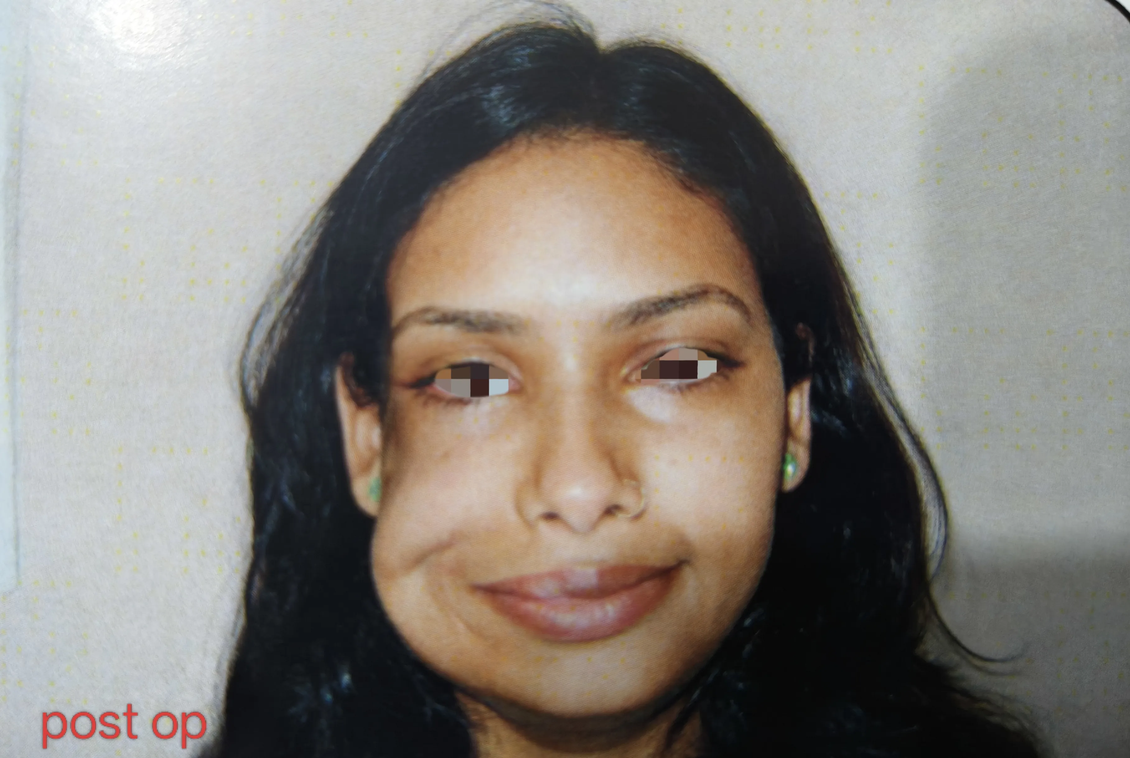 Facial Nerve Palsy — after