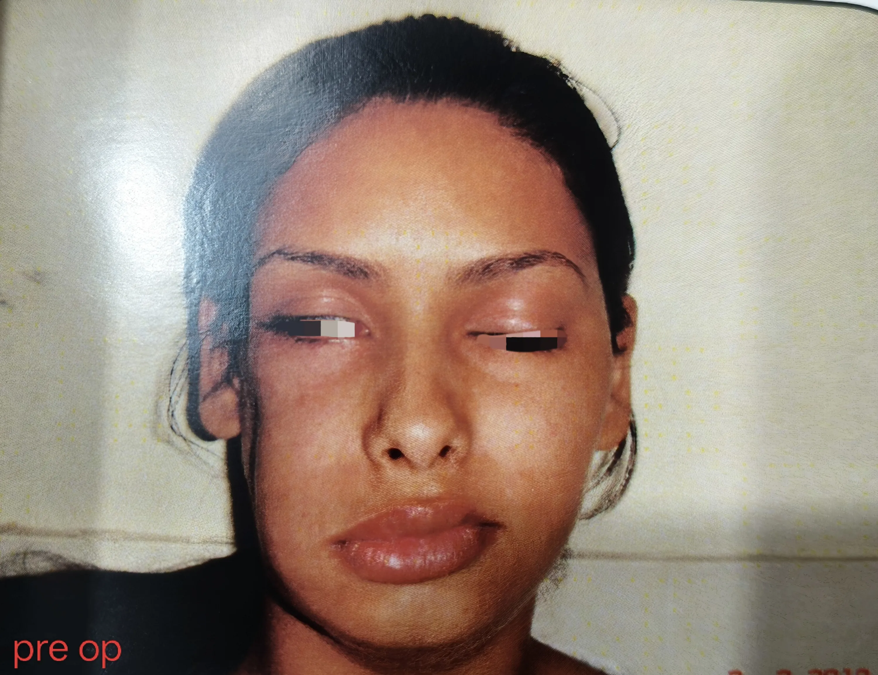 Facial Nerve Palsy — before