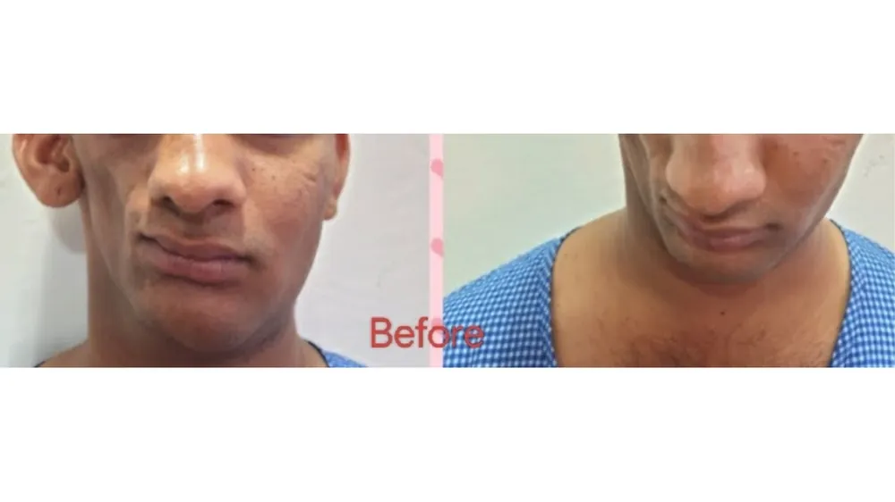 Before surgery