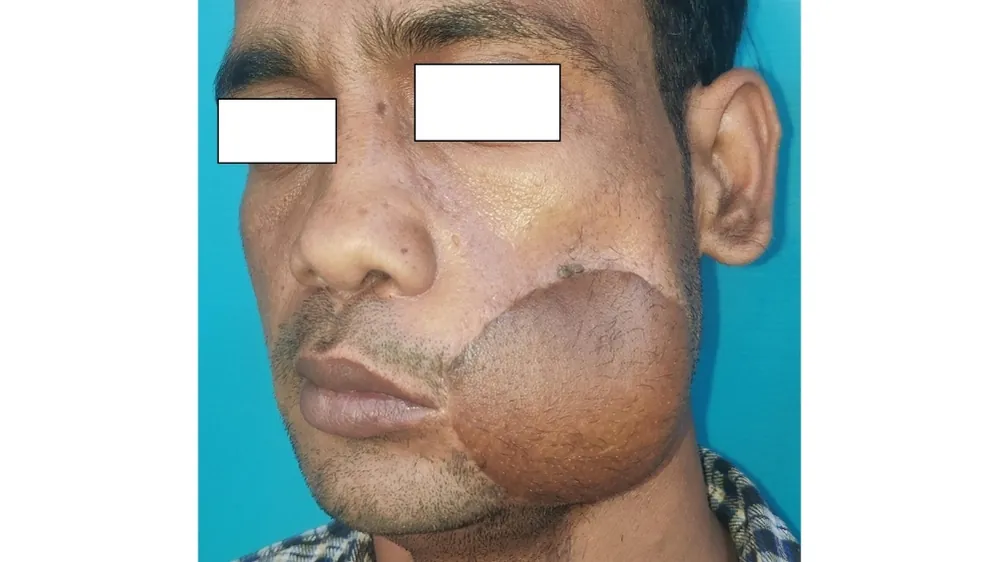Oral Cancer — after