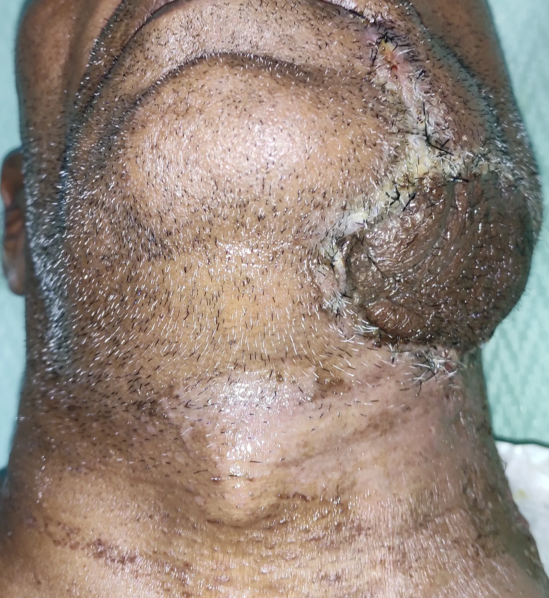 Oral Cancer — after