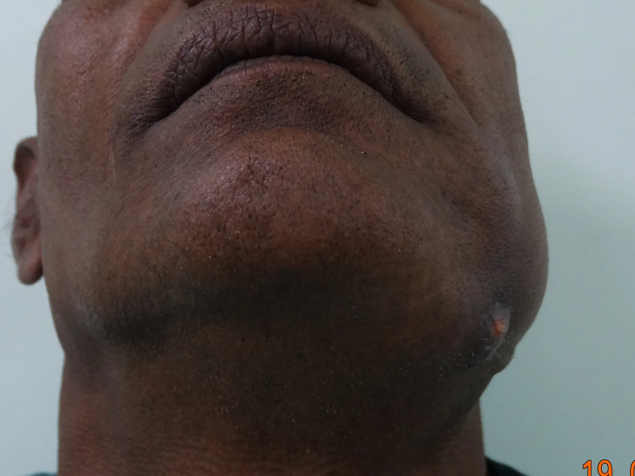 Oral Cancer — before