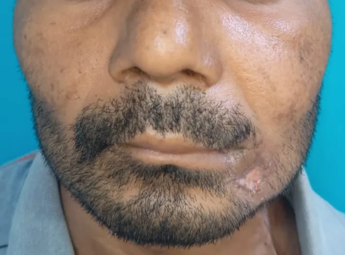 Oral Cancer — after