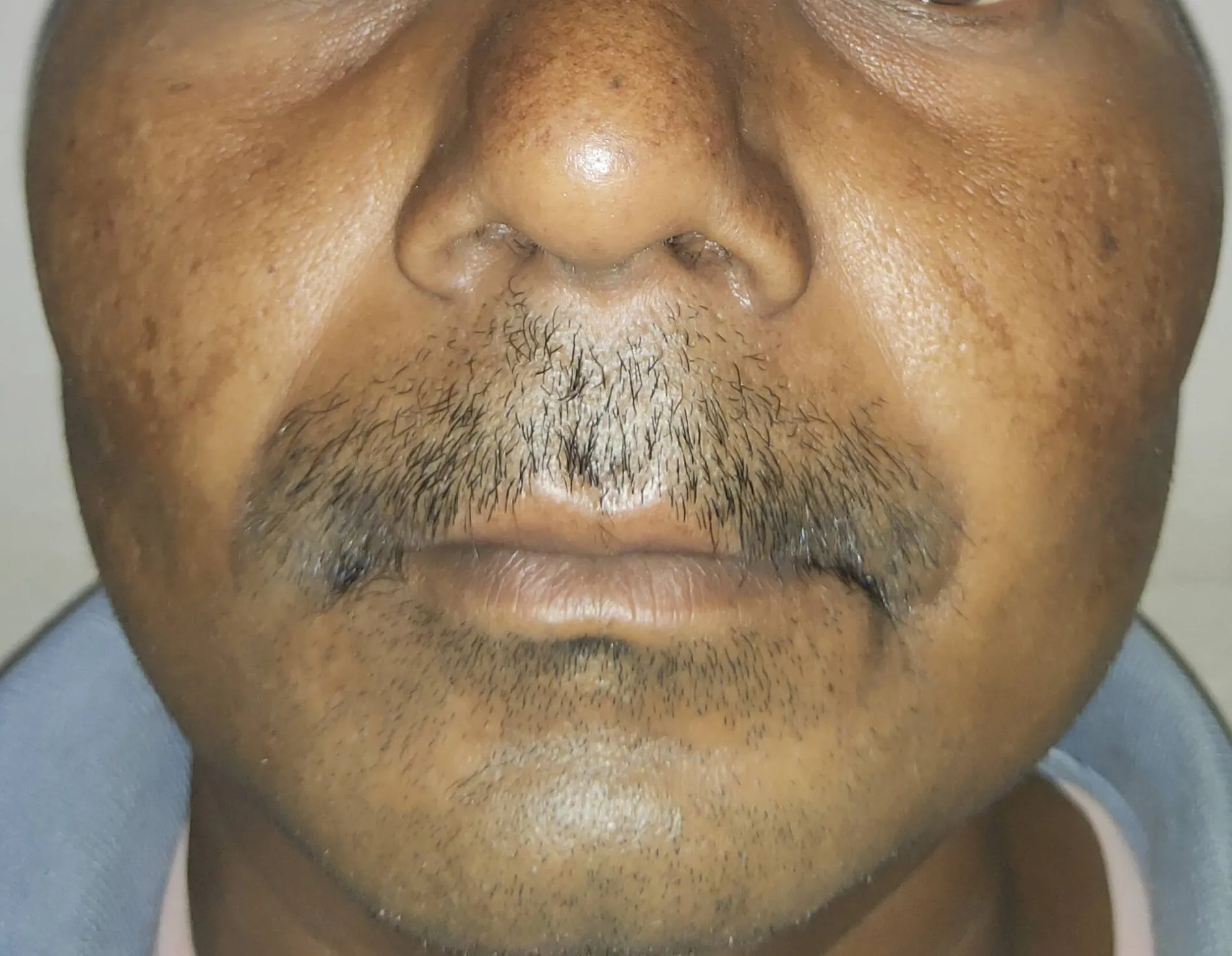 Oral Cancer — before