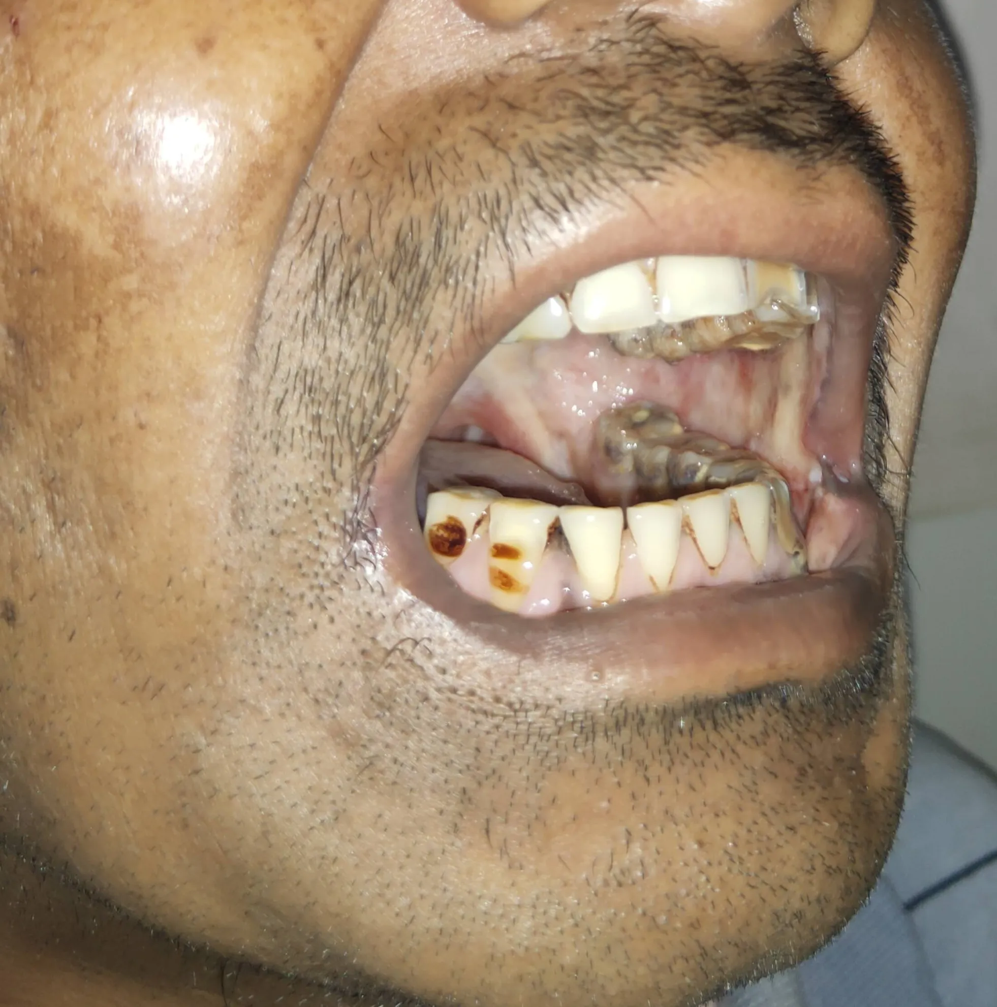 Oral Cancer — before