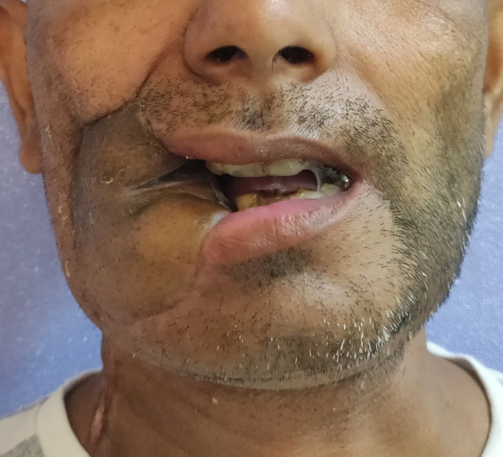 Oral Cancer — after