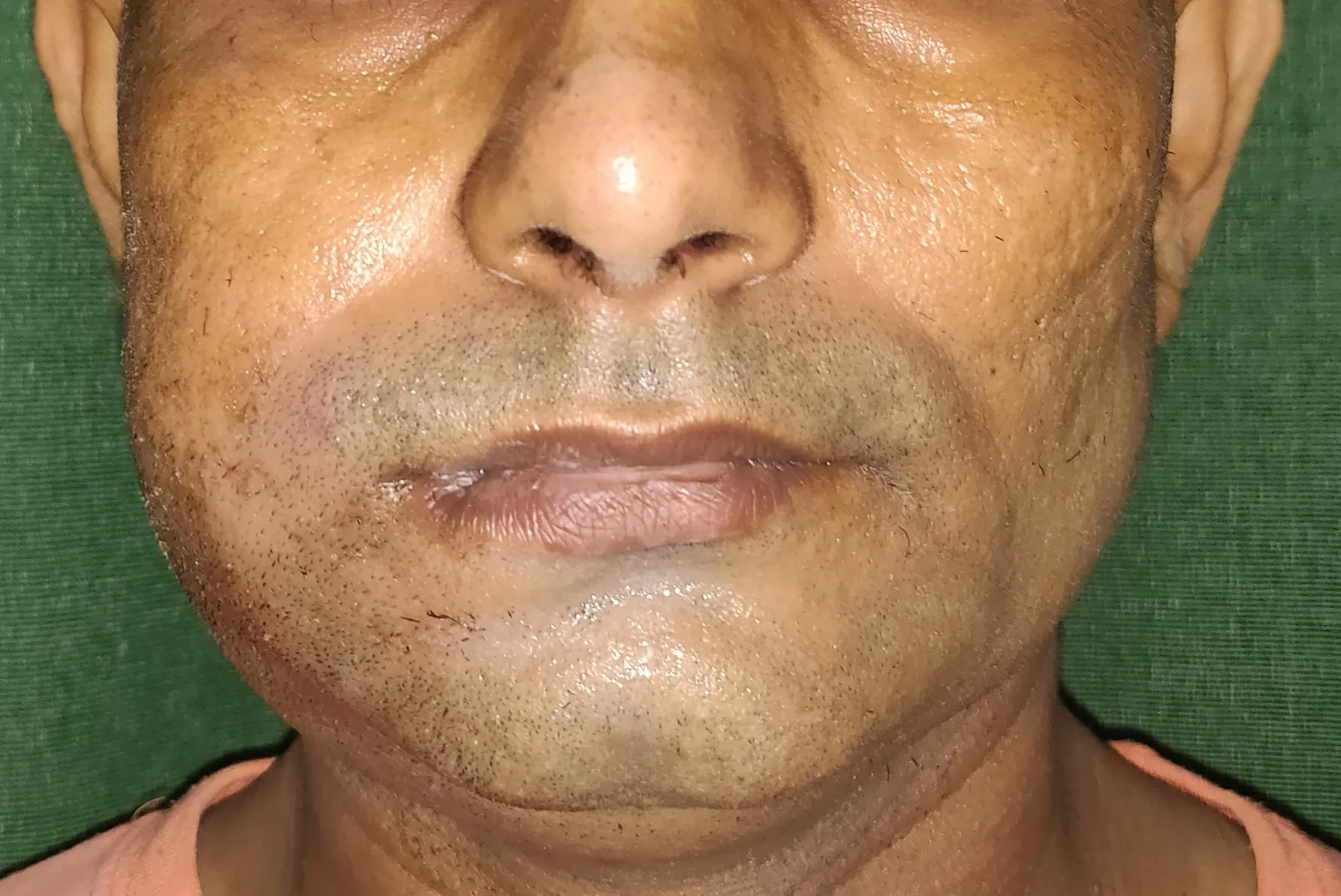Oral Cancer — before
