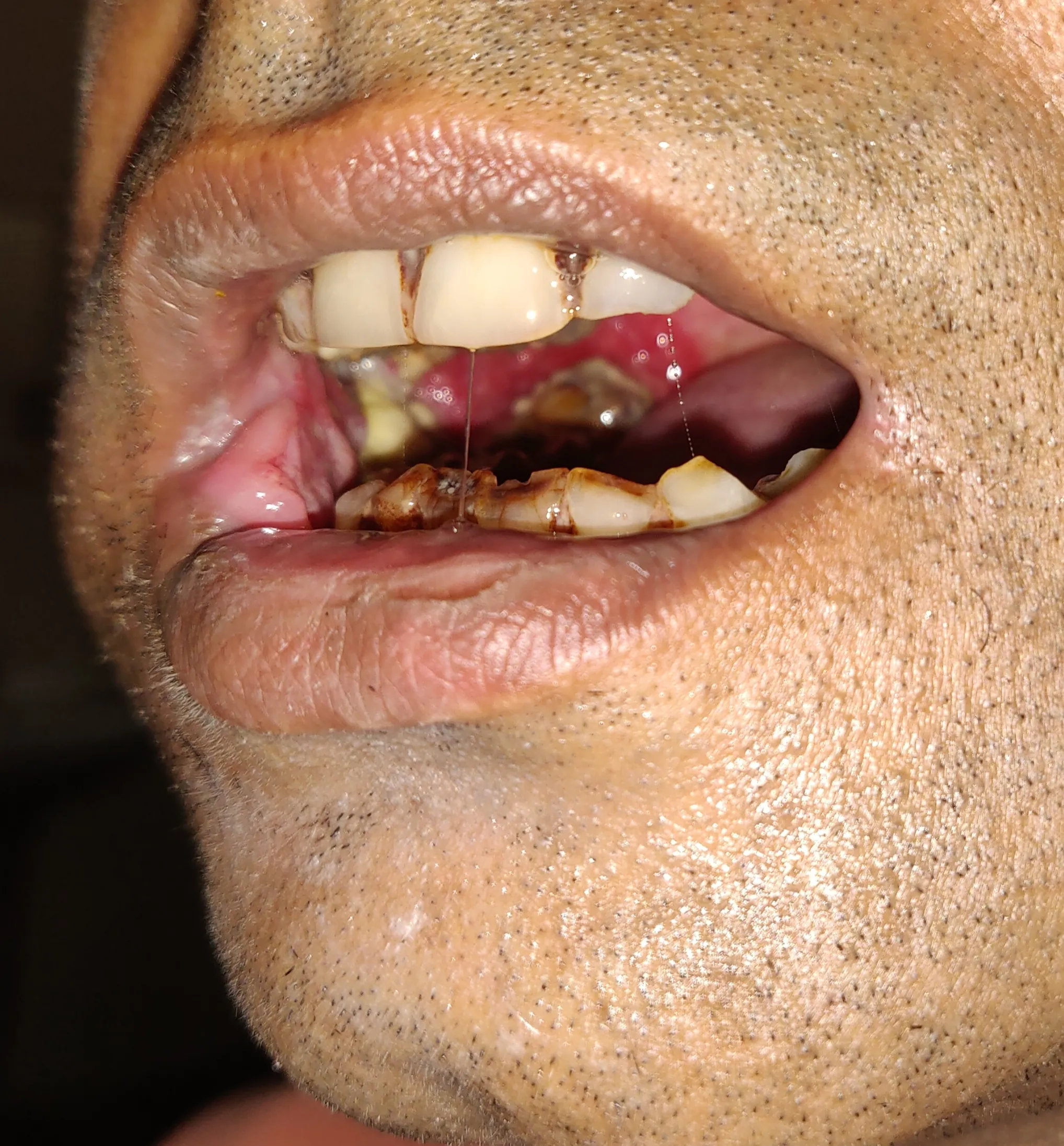 Oral Cancer — before