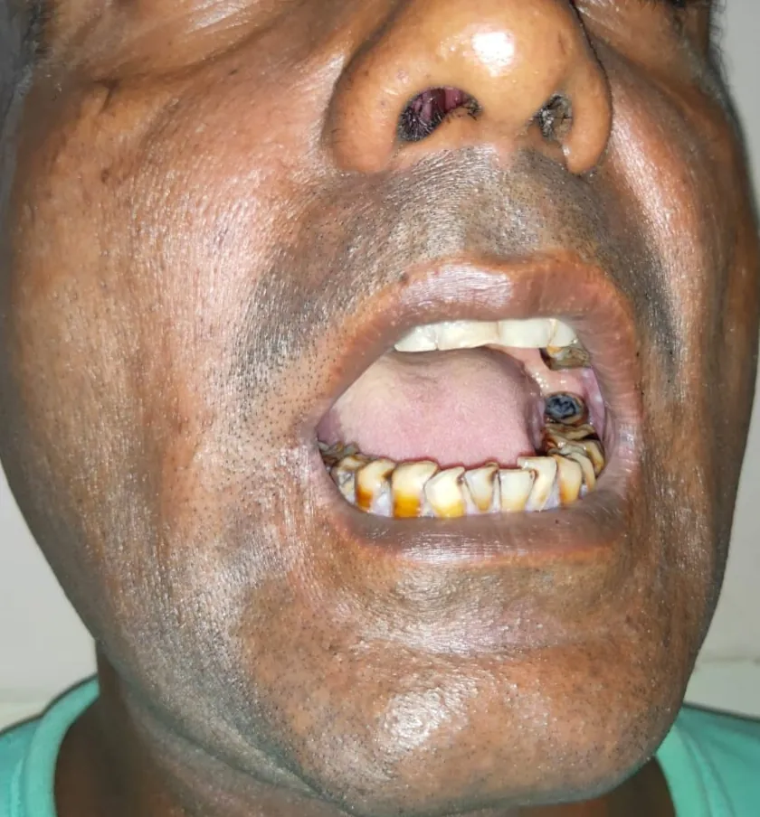 Oral Cancer — before