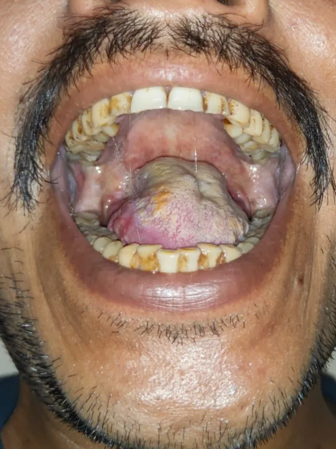 Oral Cancer — after