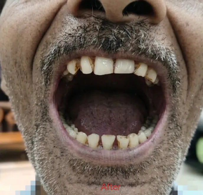 Oral Submucous Fibrosis — after
