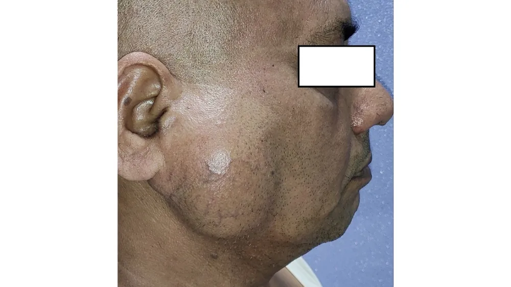 Parotid Tumor — before