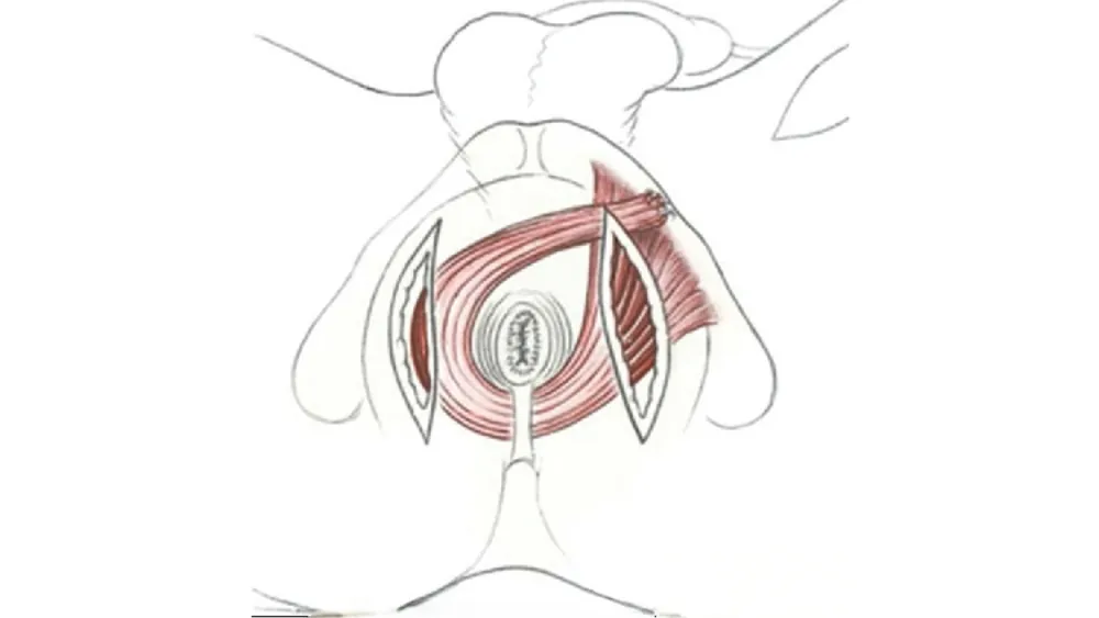 Understanding Anal Incontinence