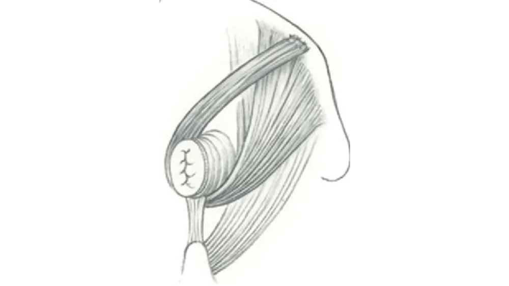Understanding Anal Incontinence