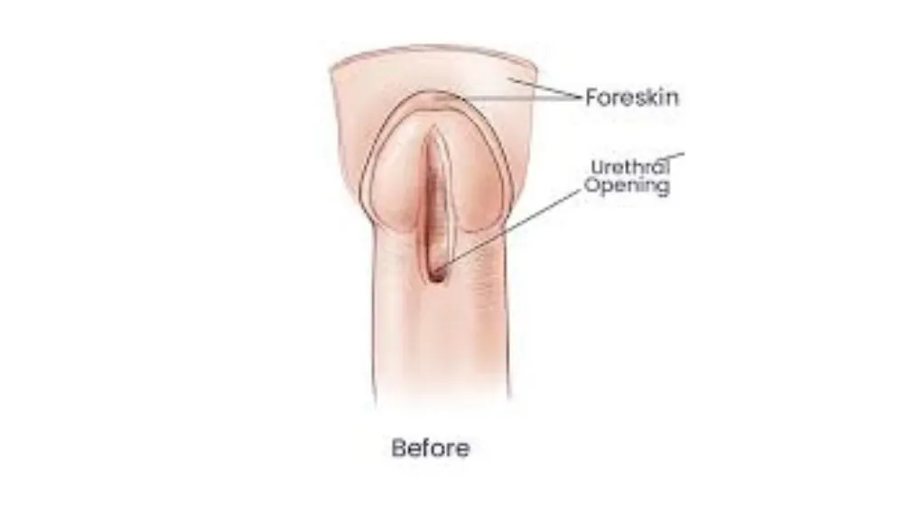 Hypospadias — before