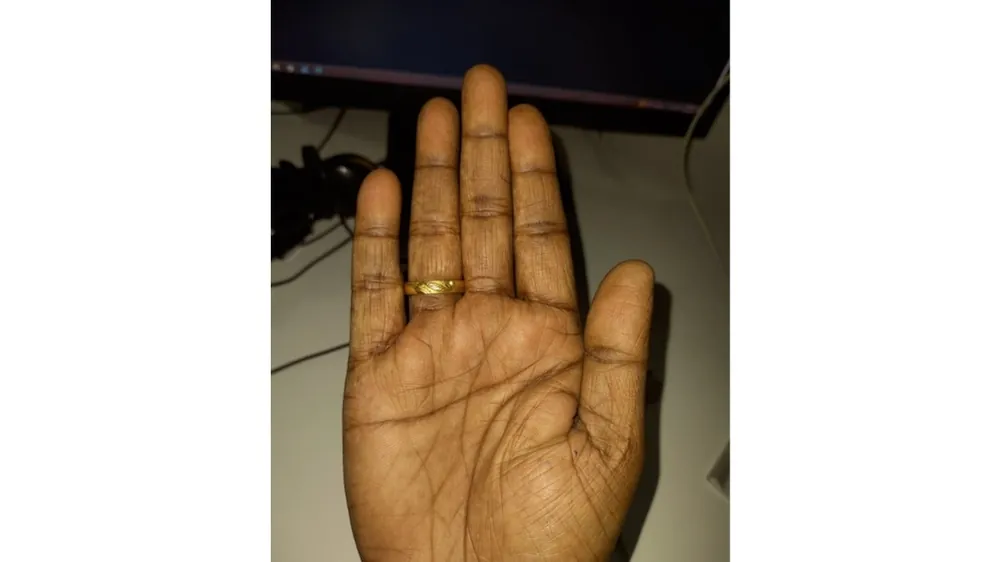 Blast Cracker Injury — after