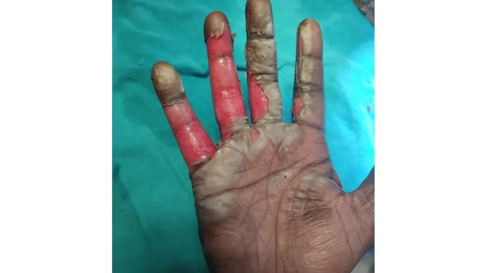 Blast Cracker Injury — before