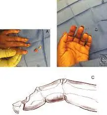 Fingertip Injuries