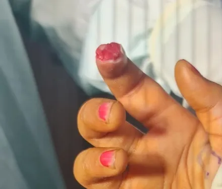 Fingertip Injuries — before