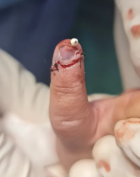 Fingertip Injuries — after