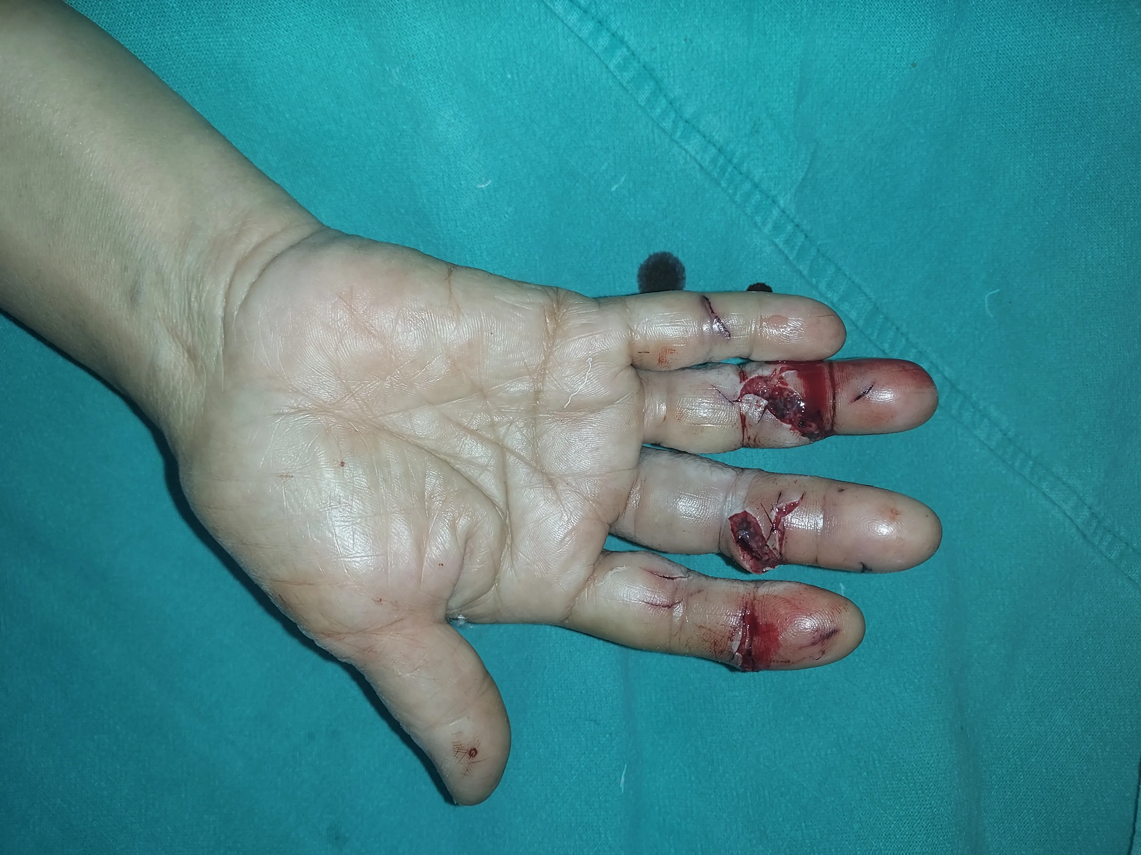 Hand Fracture — before