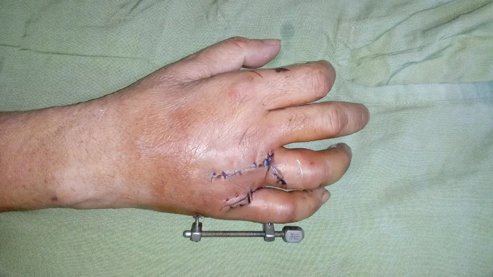 Hand Fracture — after