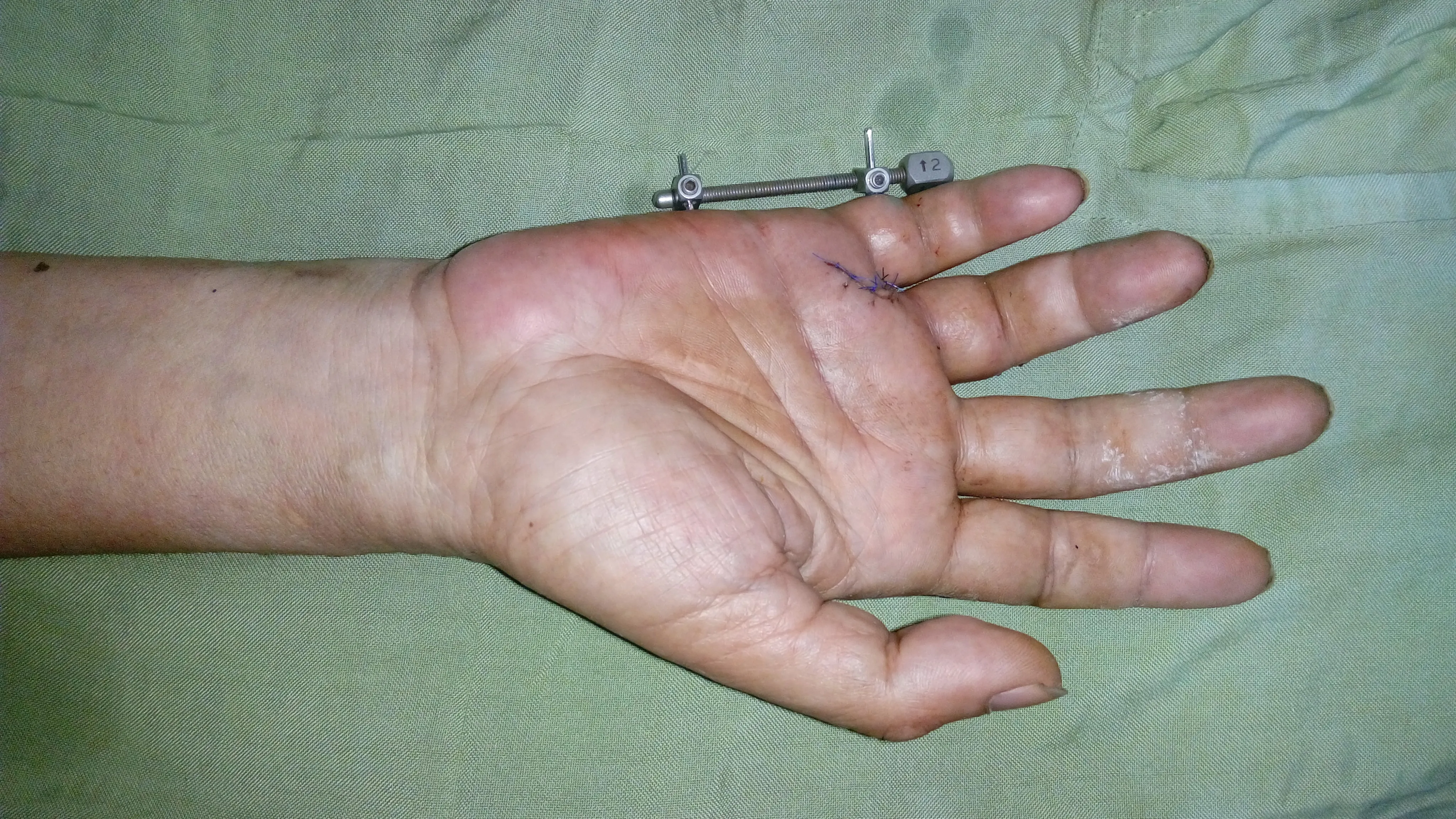 Hand Fracture — after