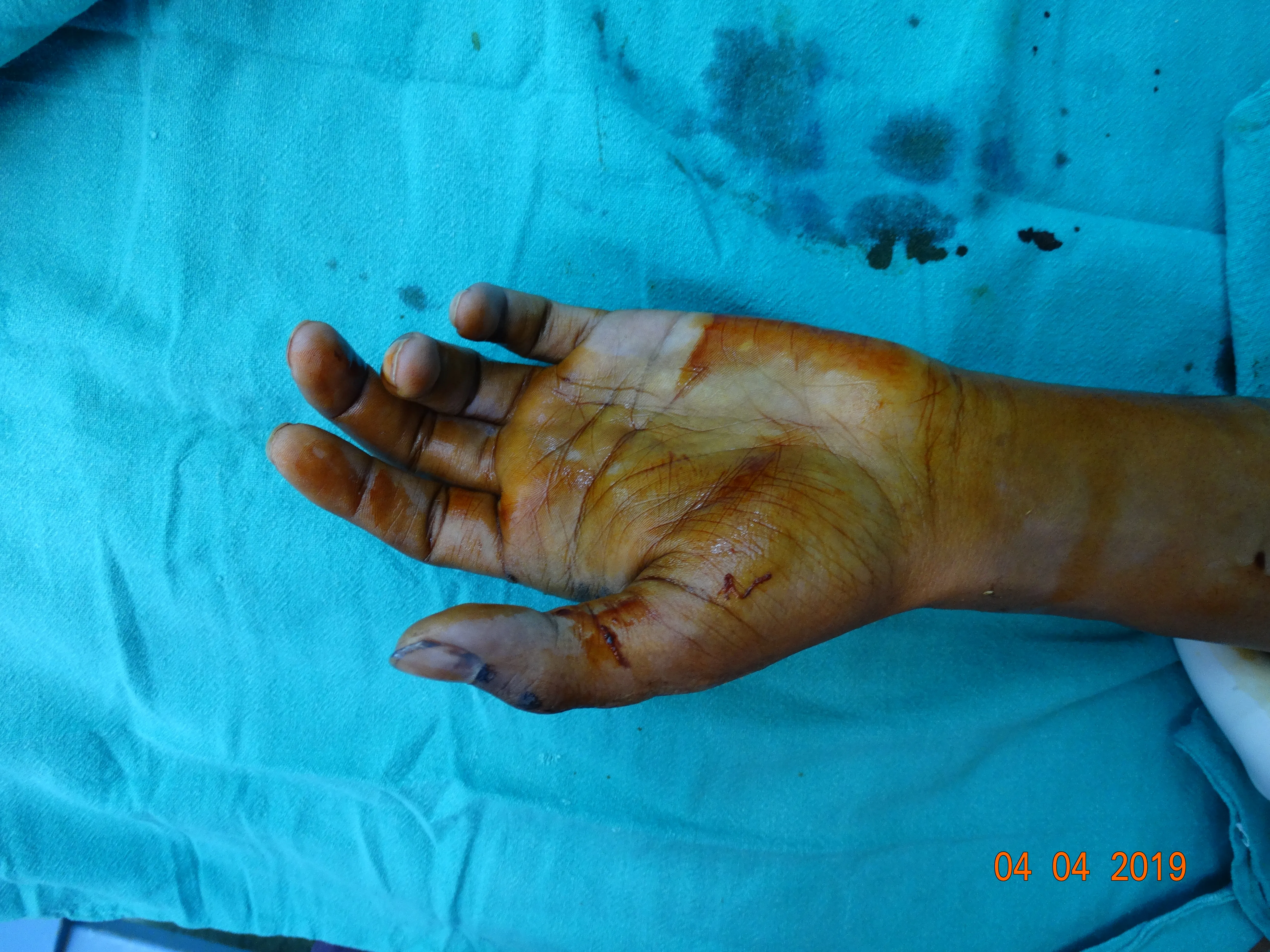 Hand Fracture — before