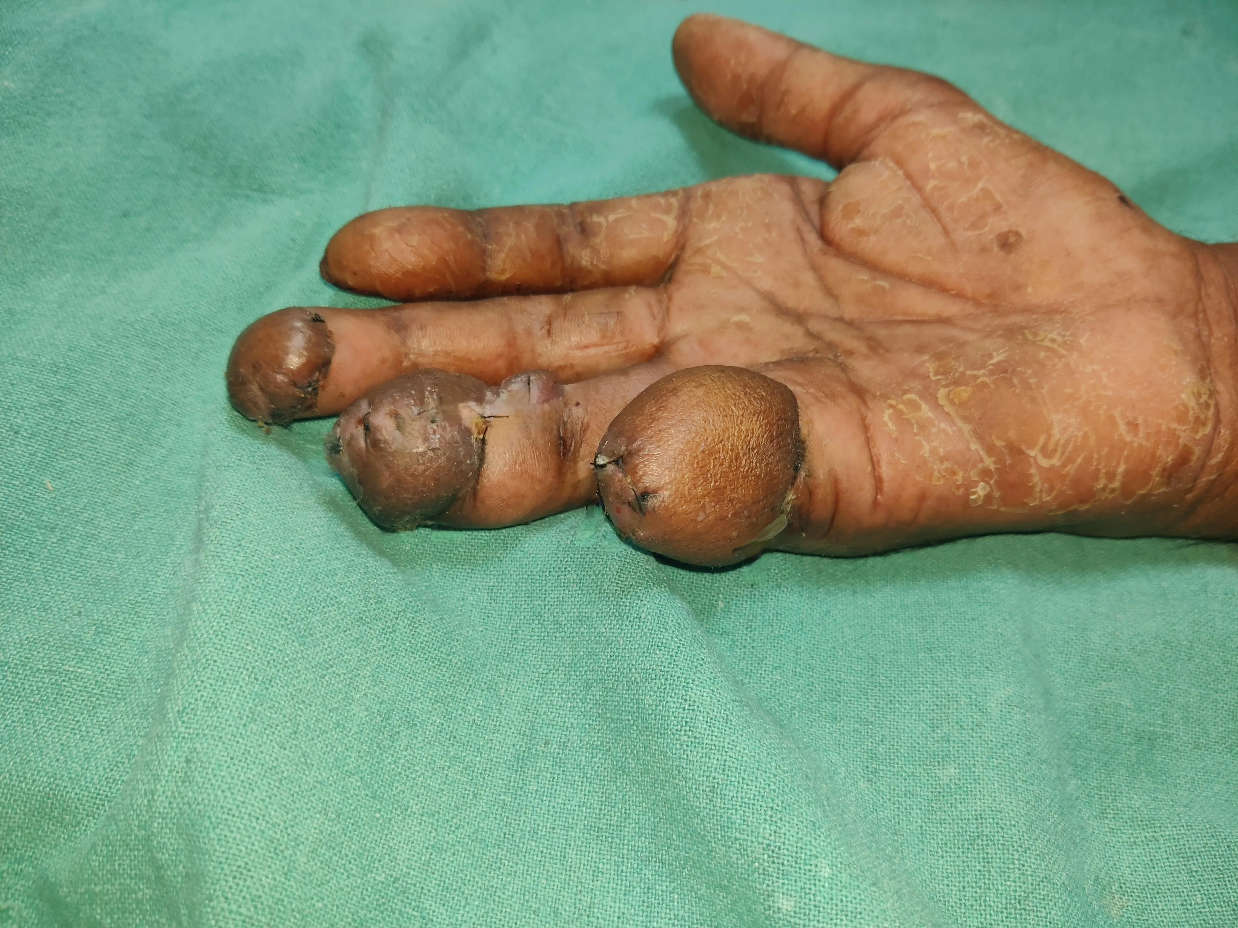 Hand Wounds — after