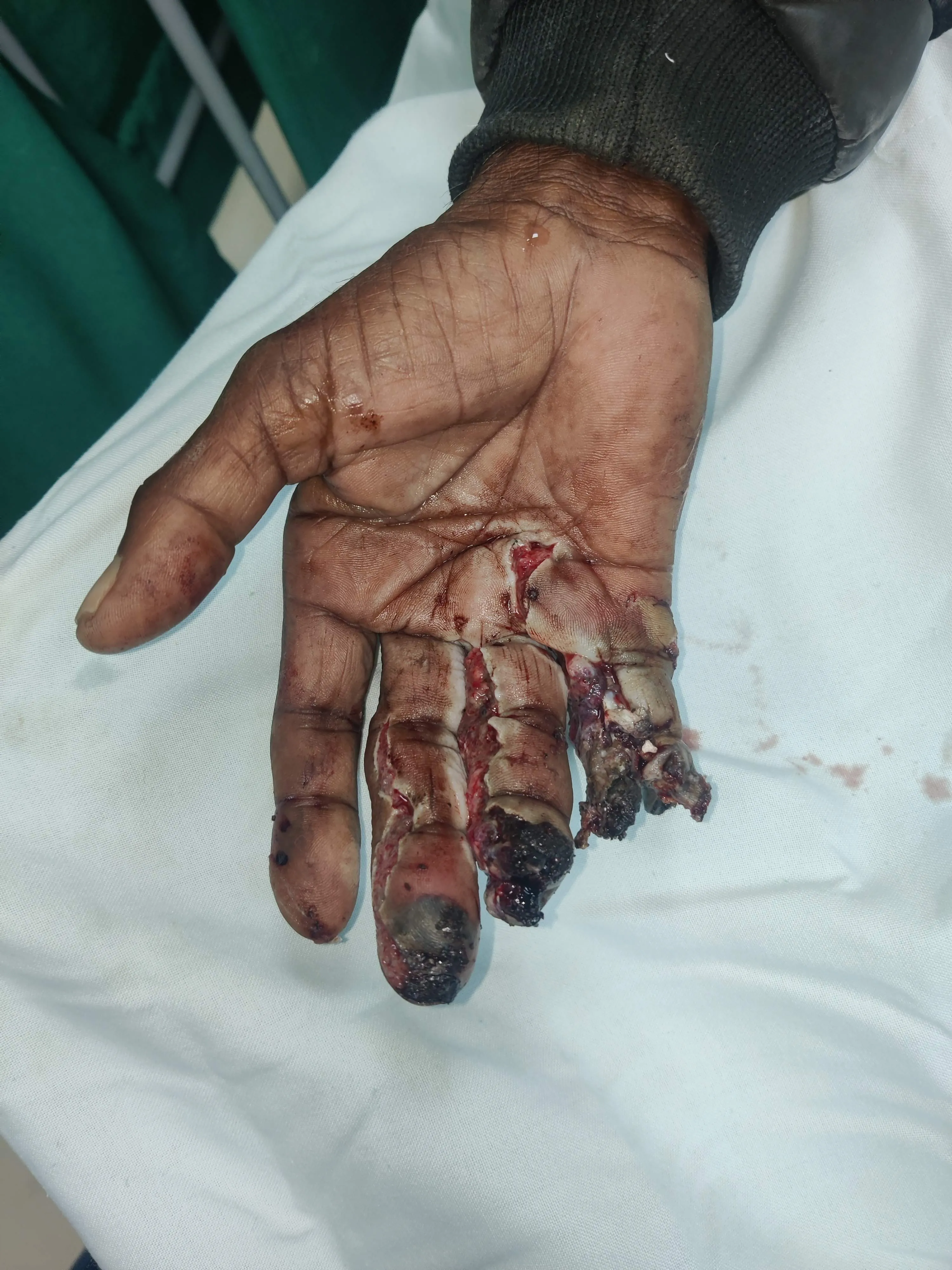 Hand Wounds — before