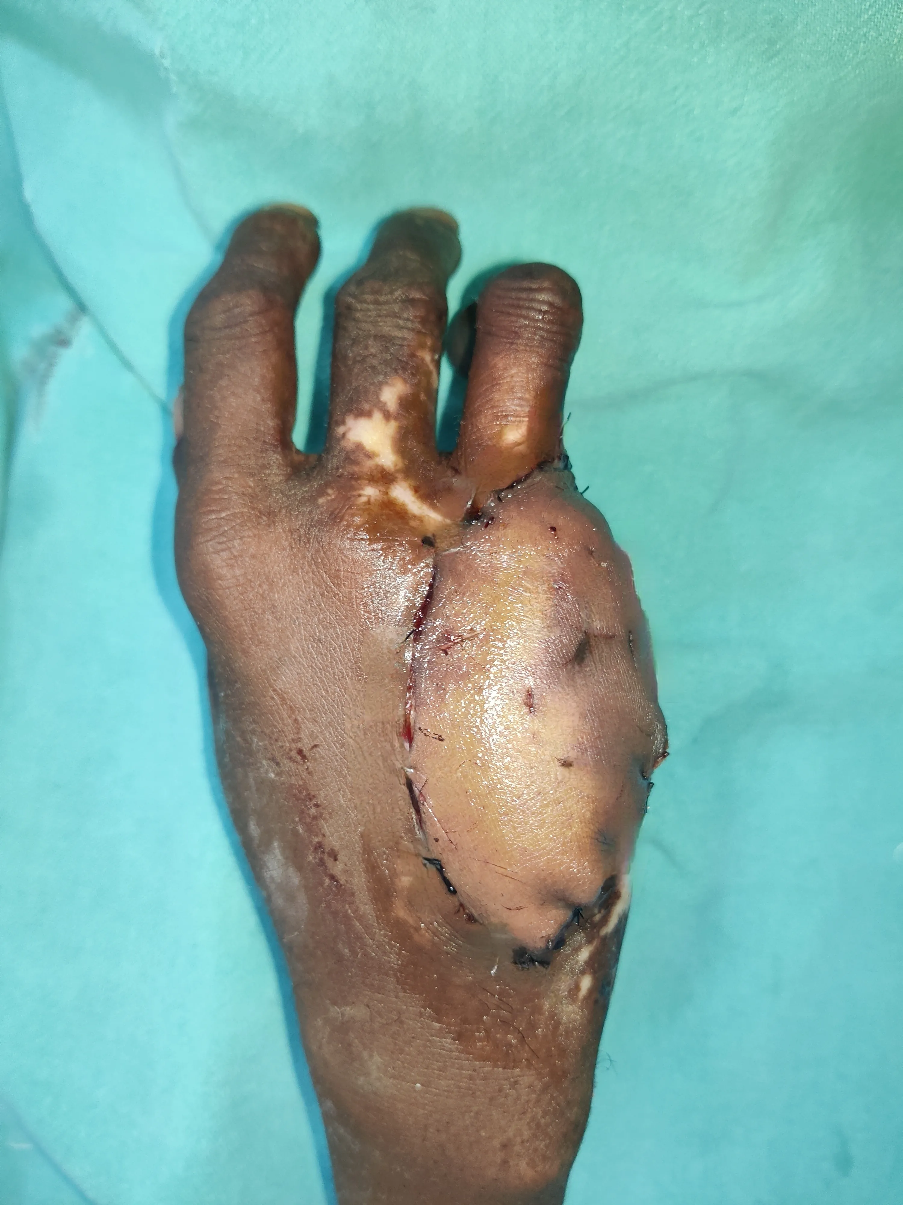 Hand Wounds — after