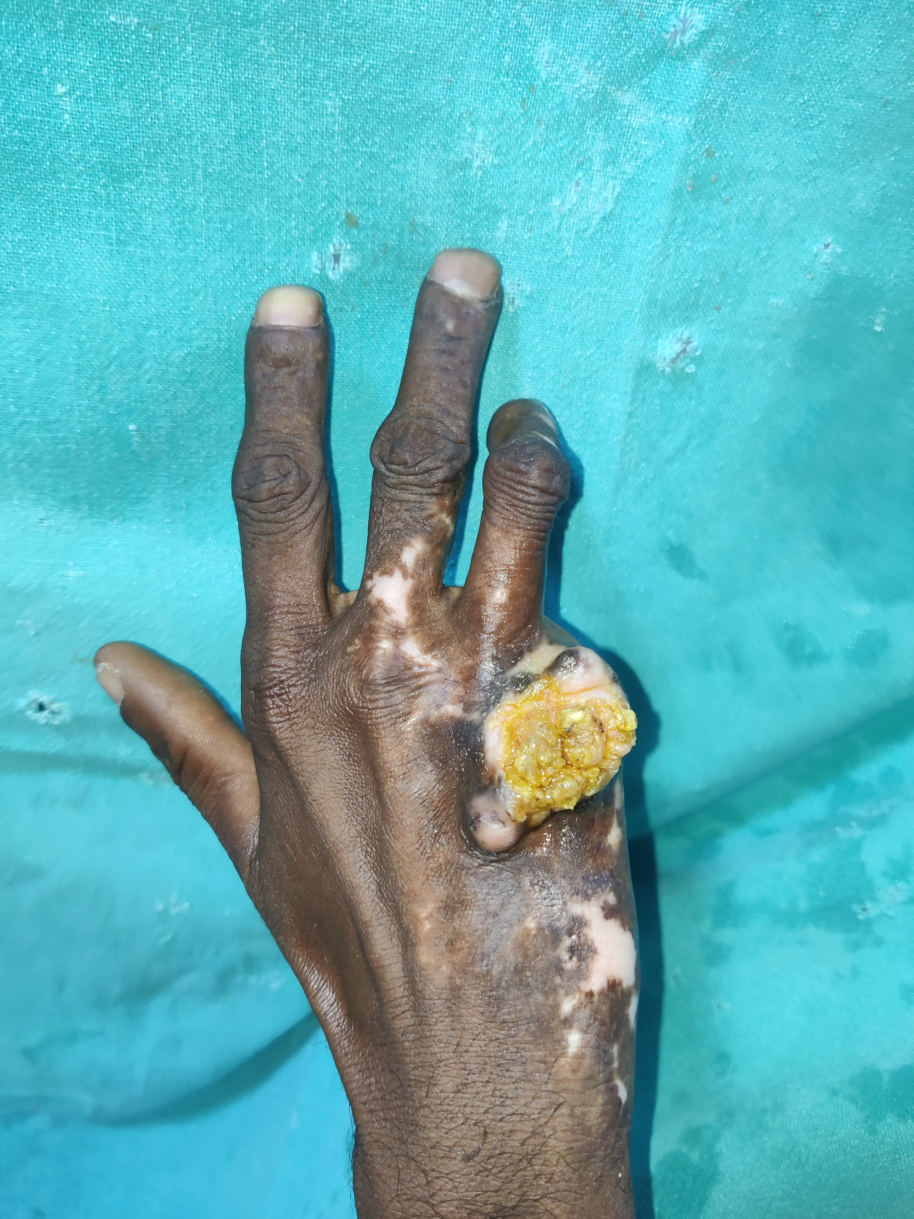Hand Wounds — before