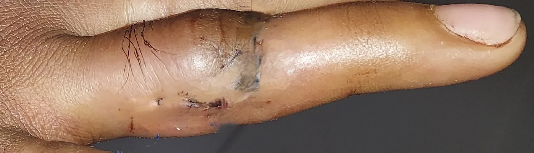 Hand Wounds — after