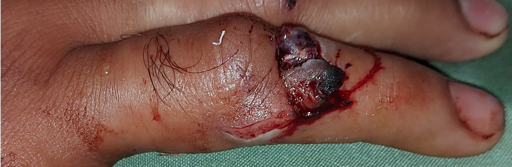 Hand Wounds — before