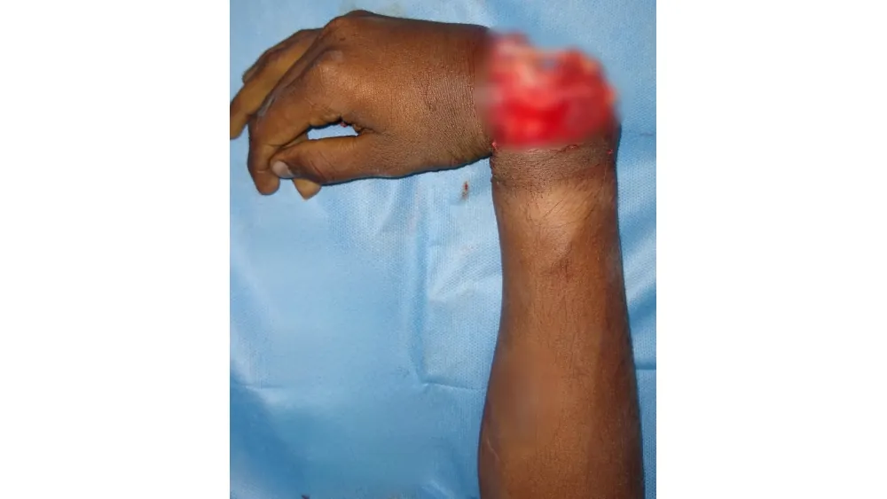 Reimplantation Surgery — before
