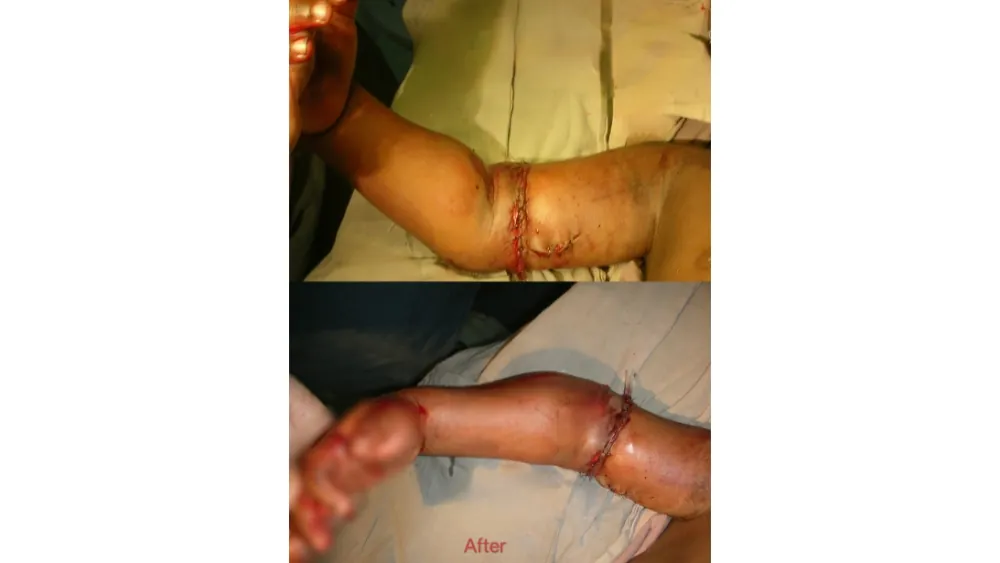 Reimplantation Surgery — after