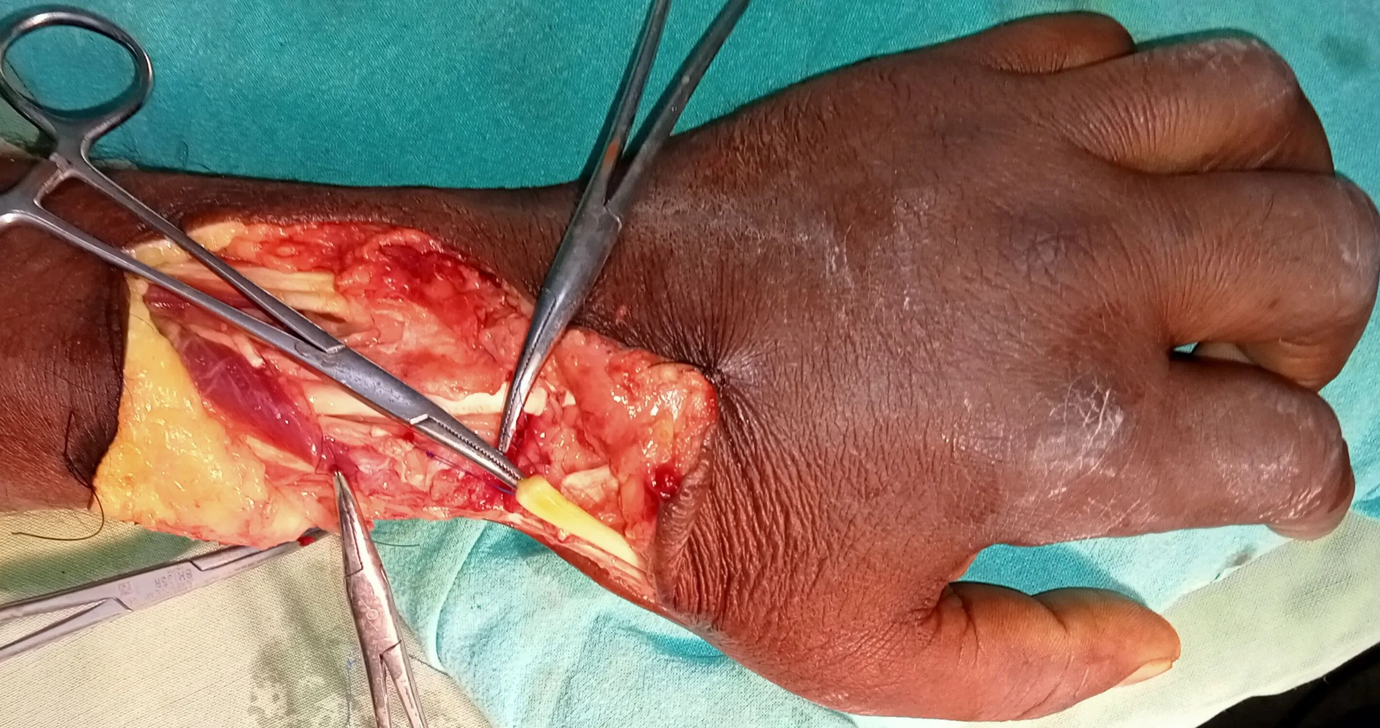 Tendon Artery Nerve Damage — before